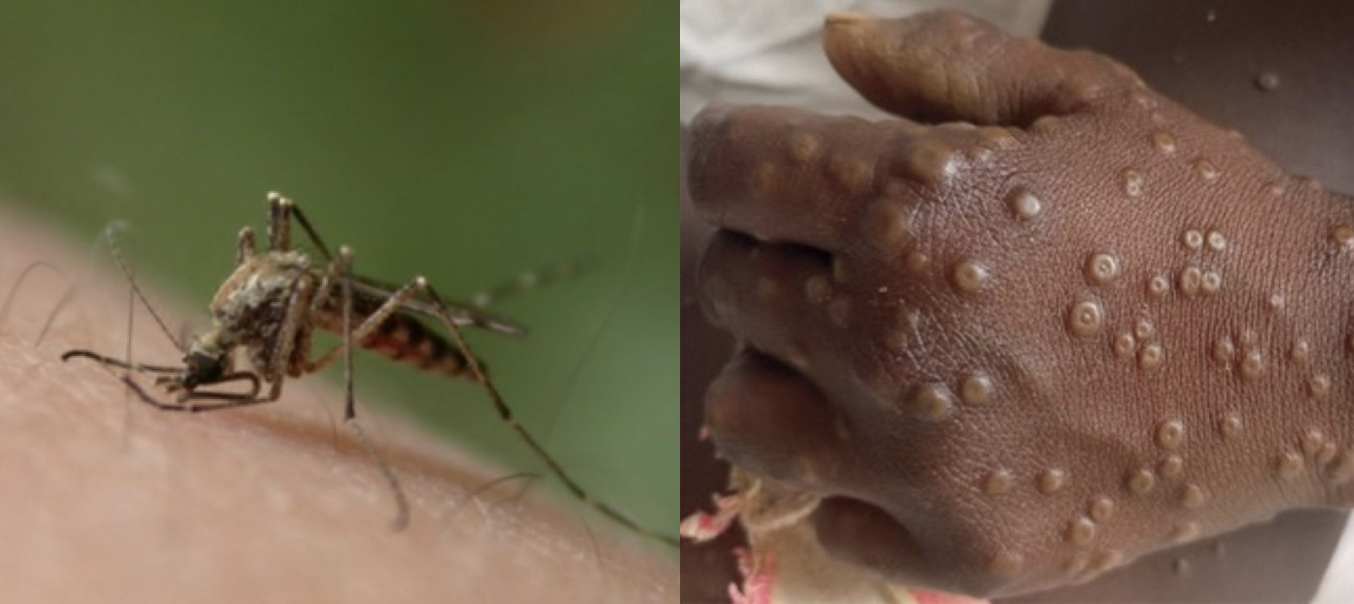Malaria and Mpox Cases Rising in Mayotte